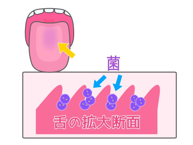 舌苔の解説イラスト
